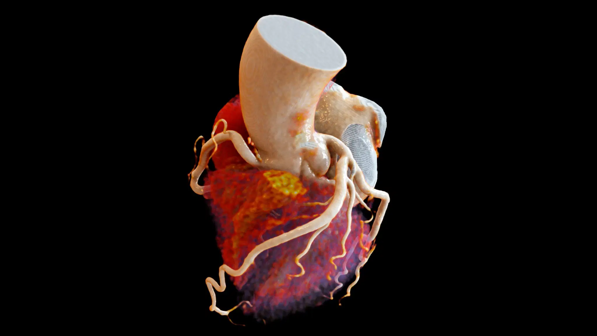 Cinematic Rendering heart example from Siemens Healthineers page